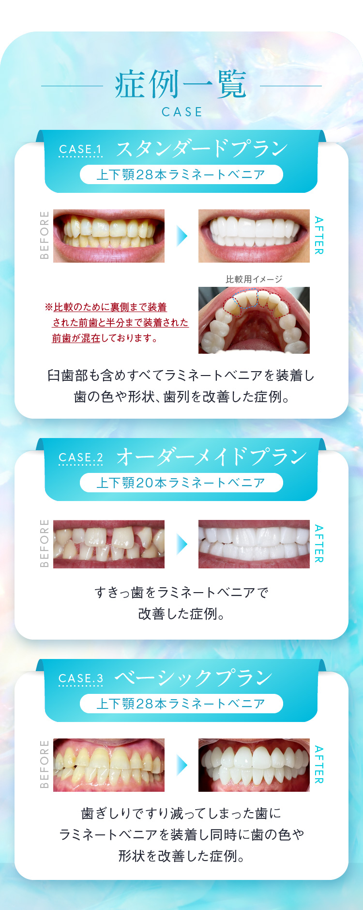 症例一覧 Case.1スタンダードプラン 上下顎28本ラミネートベニア Case.2 オーダーメイドプラン 上下顎20本ラミネートベニア Case.3 ベーシックプラン 上下顎28本ラミネートベニア